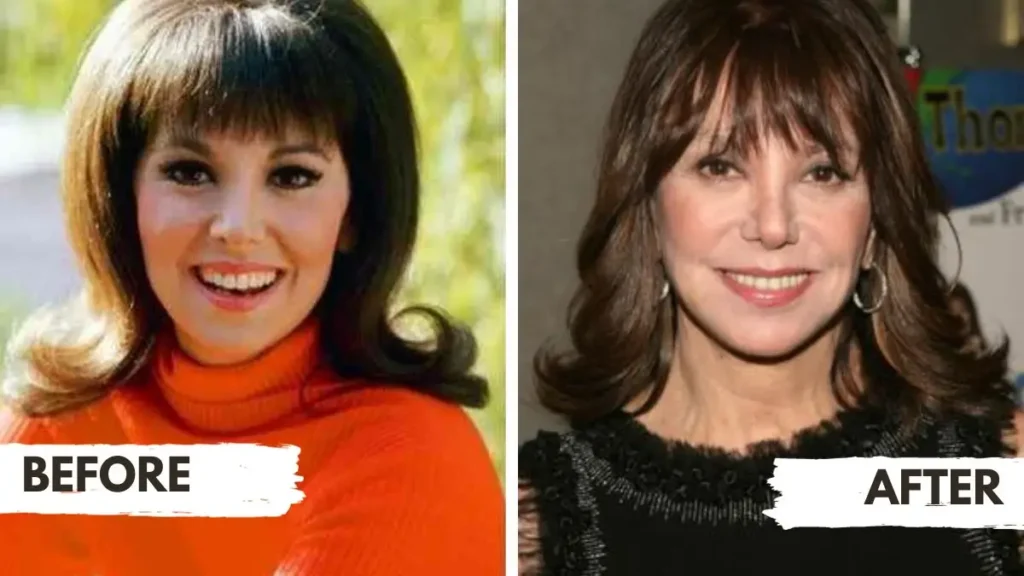 Marlo Thomas Before and After Plastic Surgery, Baddiehub.best